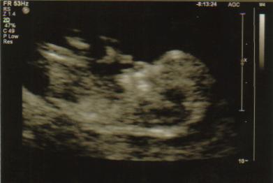 11 week ultrasound 1