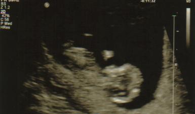 11 week ultrasound 2